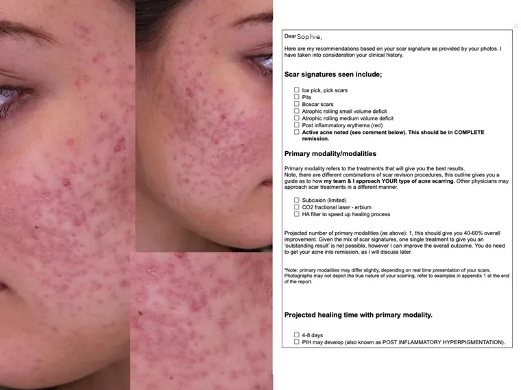 Acne scarring reviewed in detail alongside the written scar-signature assessment
