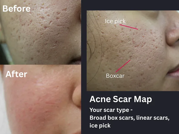 Before and after acne scar mapping from a written report