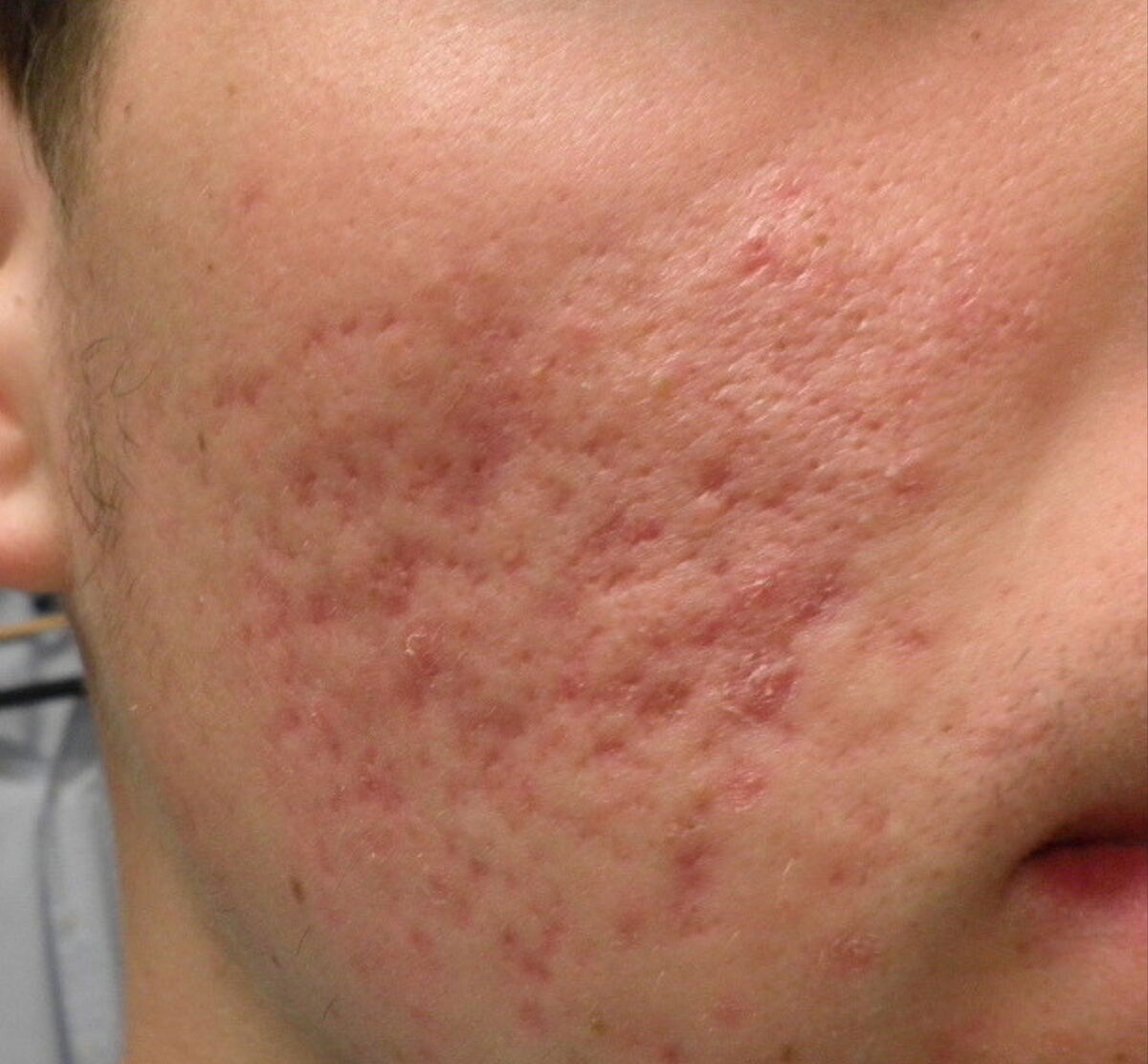 Mixed atrophic acne scars on the cheek