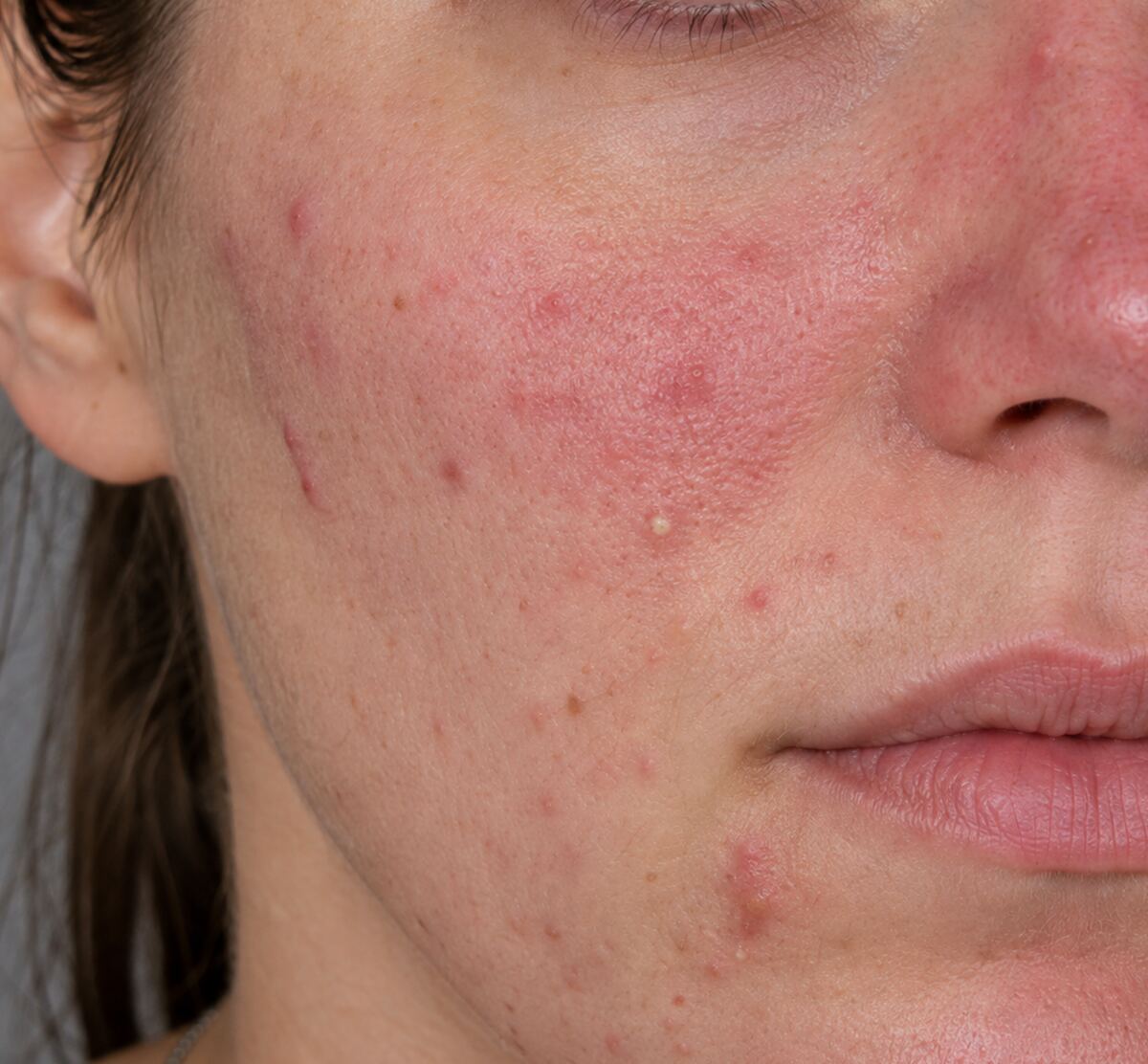 Inflamed acne spots and blocked pores on the cheek