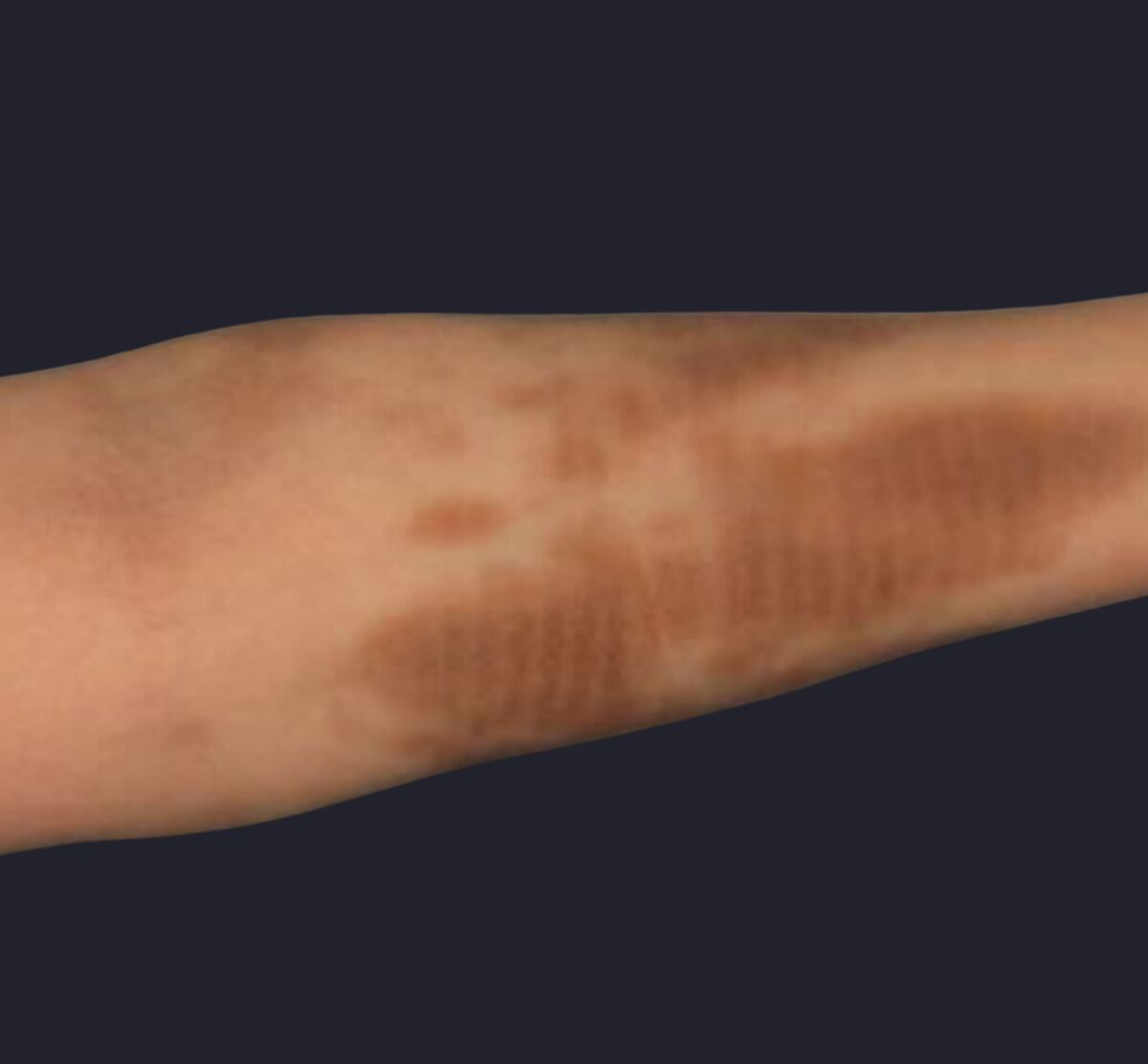 Brown iron (haemosiderin) staining on the forearm