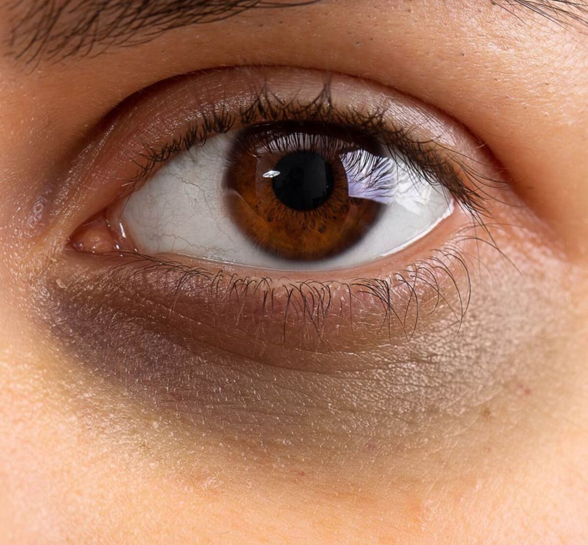 Pigmentation under the eye (dark circles)