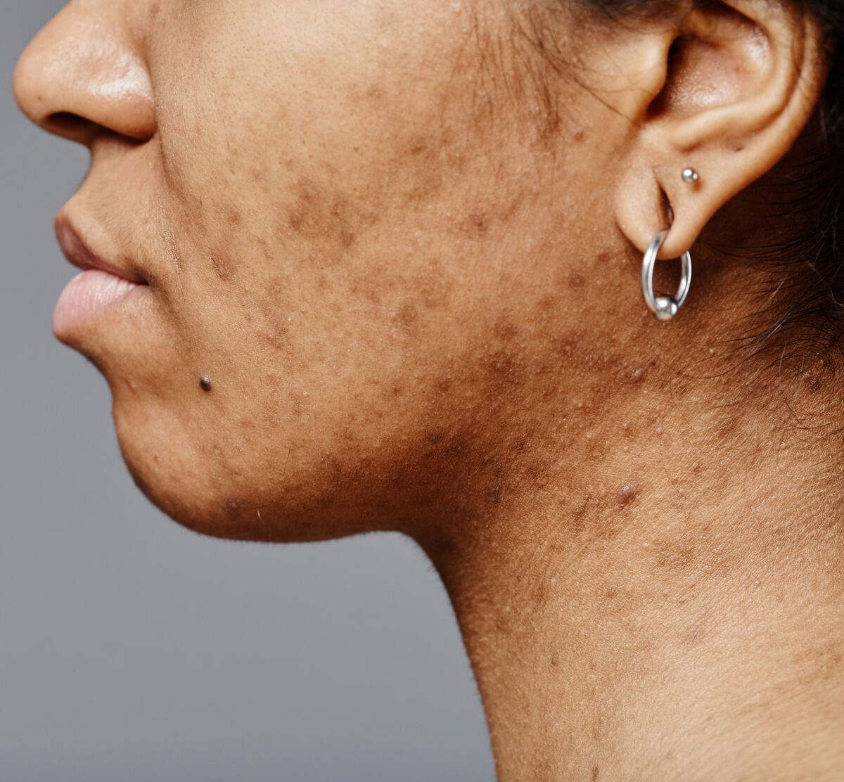 Brown post-inflammatory marks on the cheek after acne