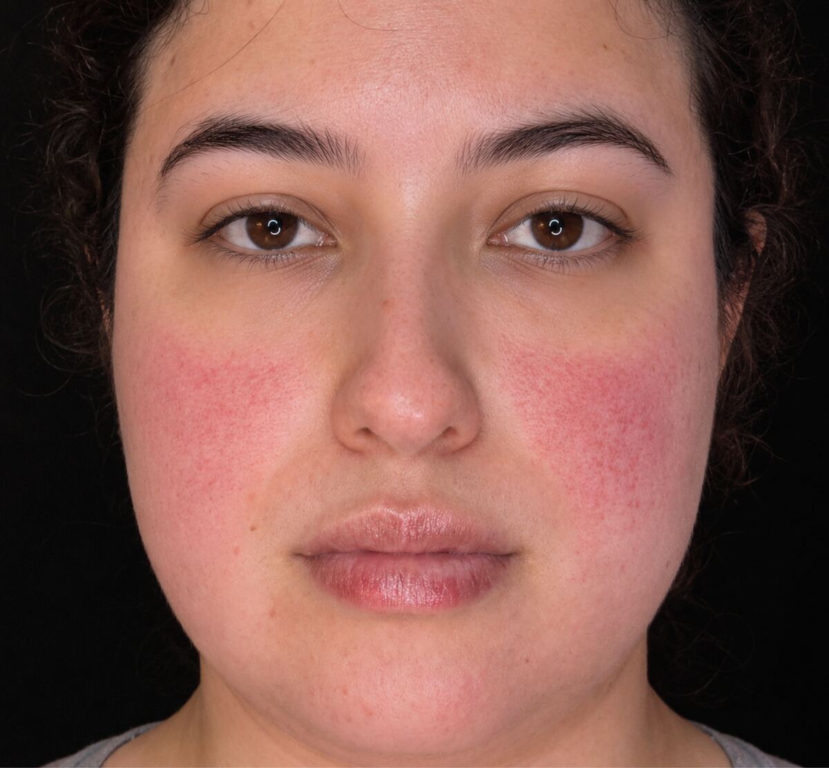 Persistent redness across both cheeks in rosacea