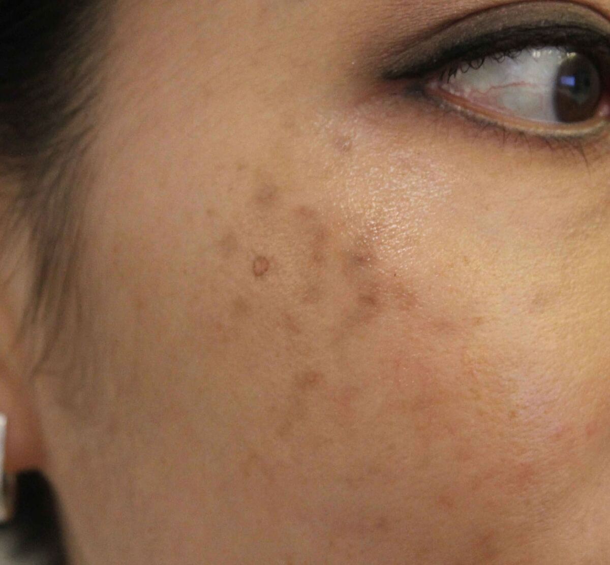 Uneven pigmentation along the jaw and neck in darker skin