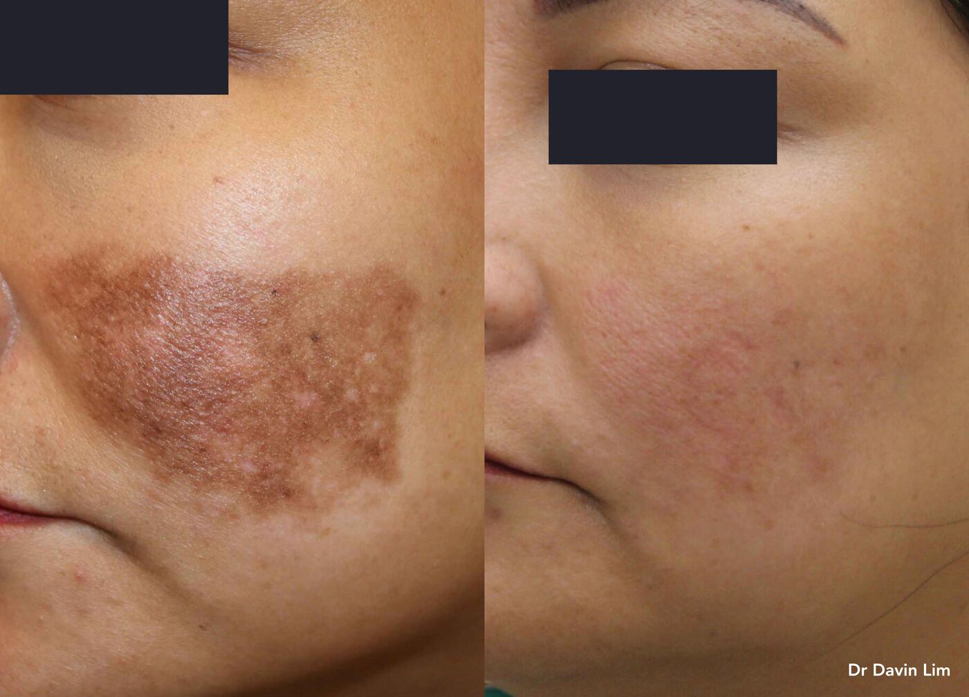 Pigmented birthmark on the cheek, before and after picosecond laser