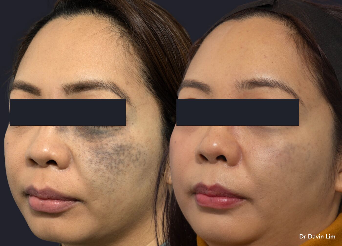 Deep dermal (naevus of Ota-type) pigment, before and after picosecond laser