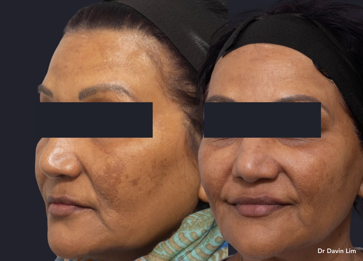 Cheek melasma in darker skin, before and after picosecond laser with topicals