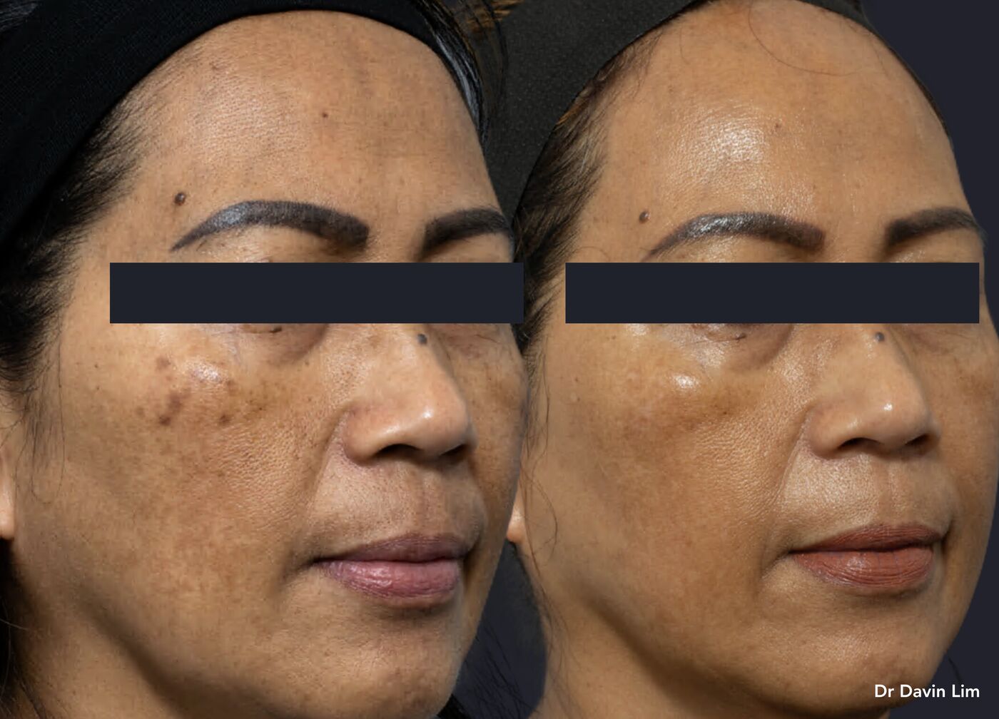 Mixed pigment in skin of colour, before and after picosecond laser