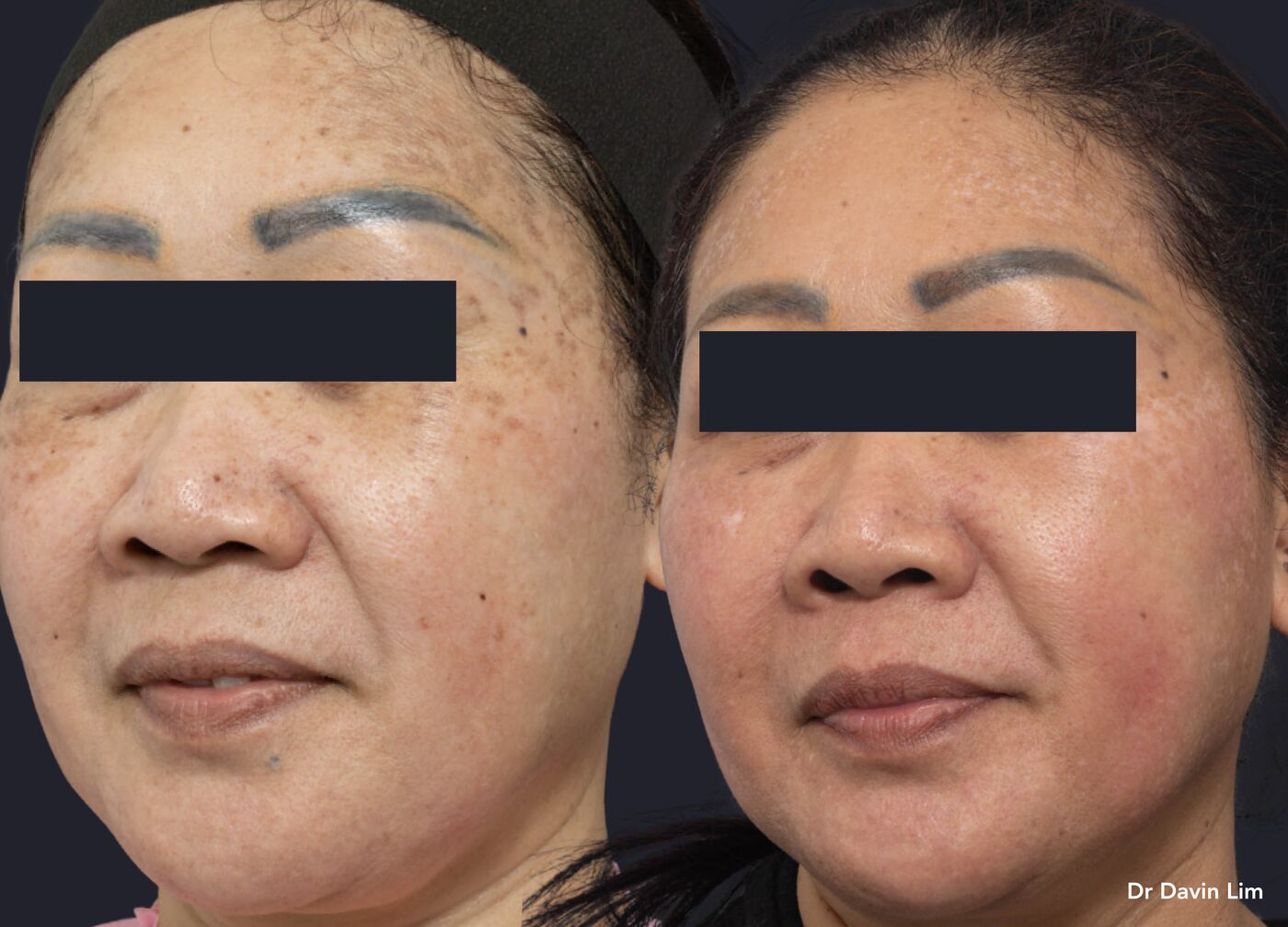 Widespread sun spots in Asian skin, before and after picosecond laser