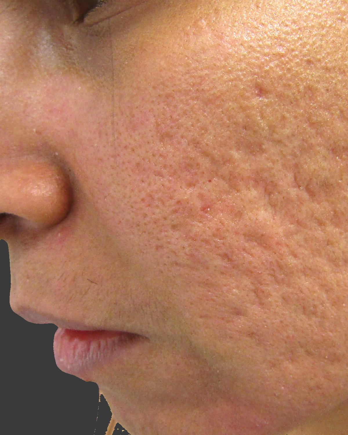 Before treatment