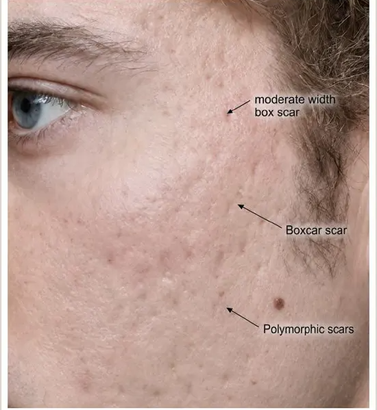 Acne scars