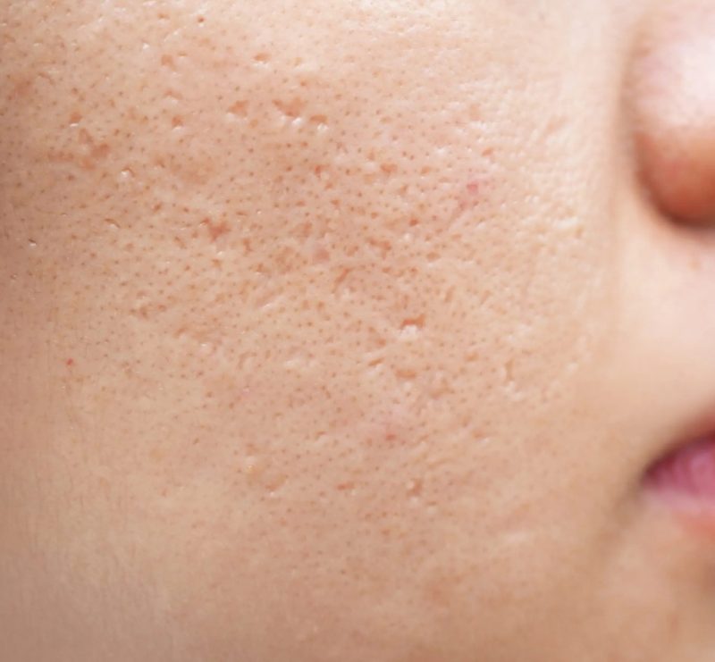Acne scarring