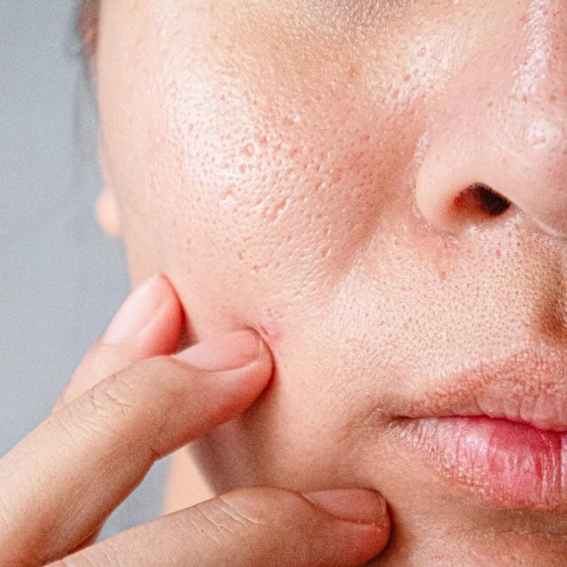 Enlarged pores