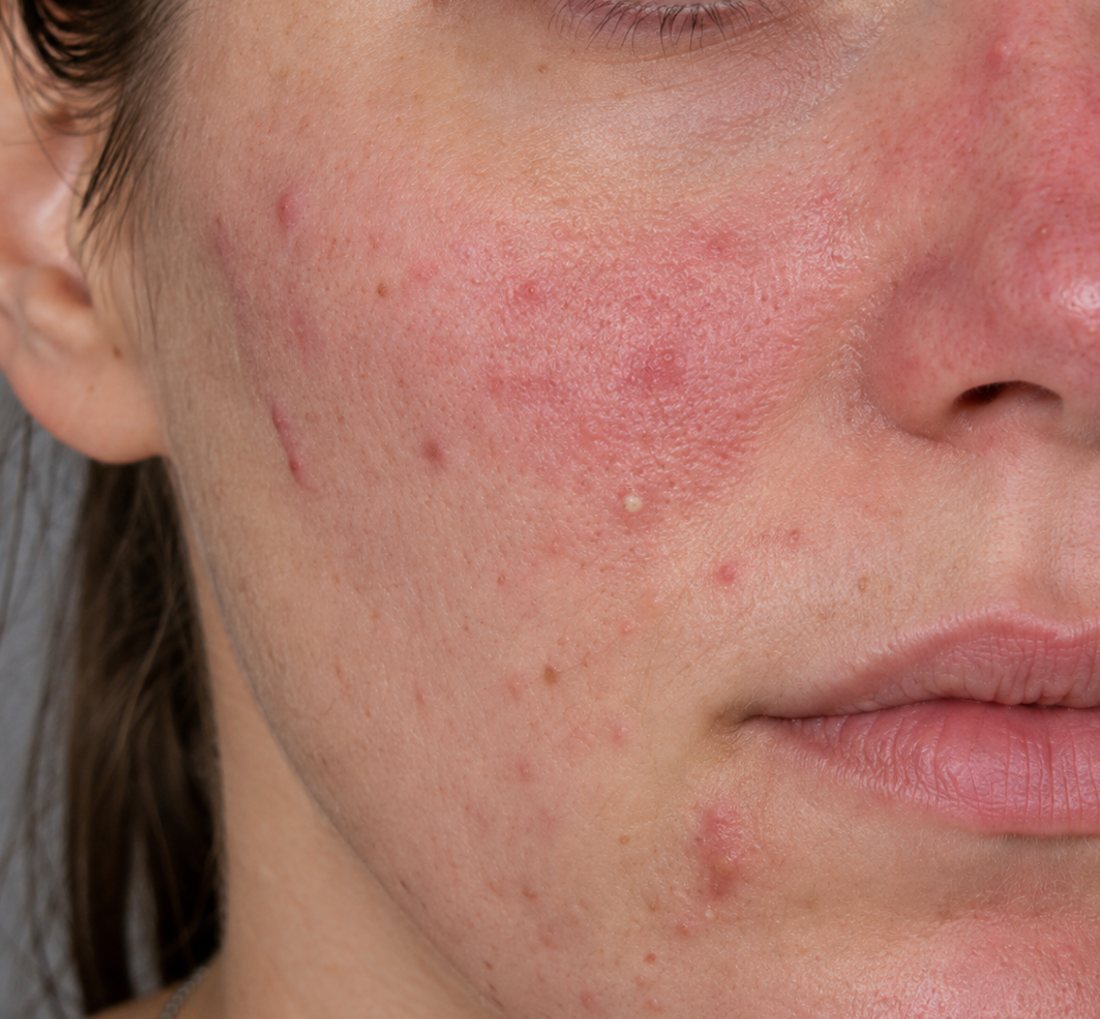 Active inflammatory acne on the cheek with early red marks