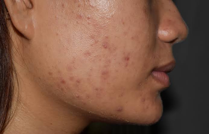 Flat brown marks after acne on the cheek and jaw — post-inflammatory hyperpigmentation