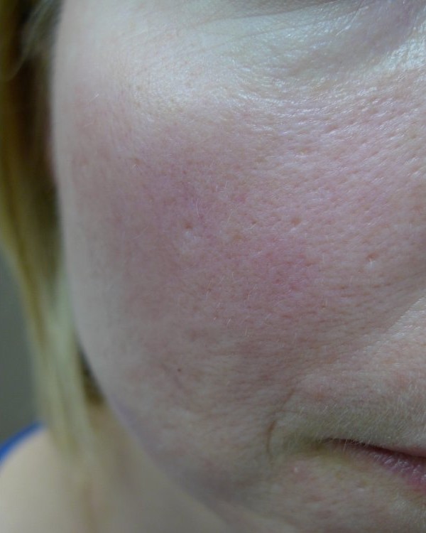 After erbium laser resurfacing. Lighter skin, treated to the scar floor.