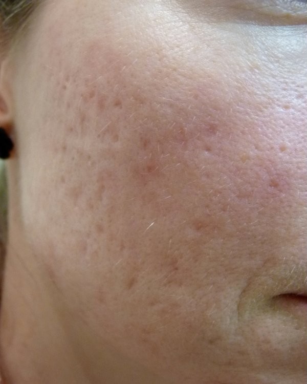 Shallow boxcar scarring and redness across the cheek.