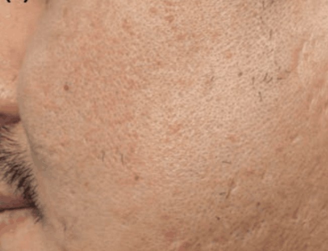 Healed by secondary intention, with no additional scarring.