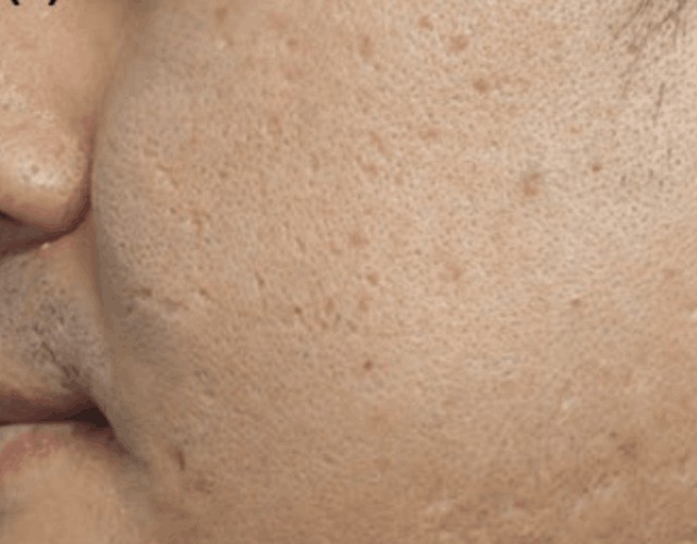 Isolated ice pick scars on the cheek.
