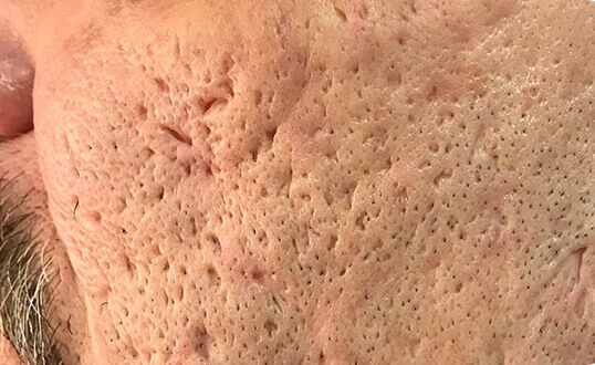 Severe, dense ice pick and boxcar acne scarring