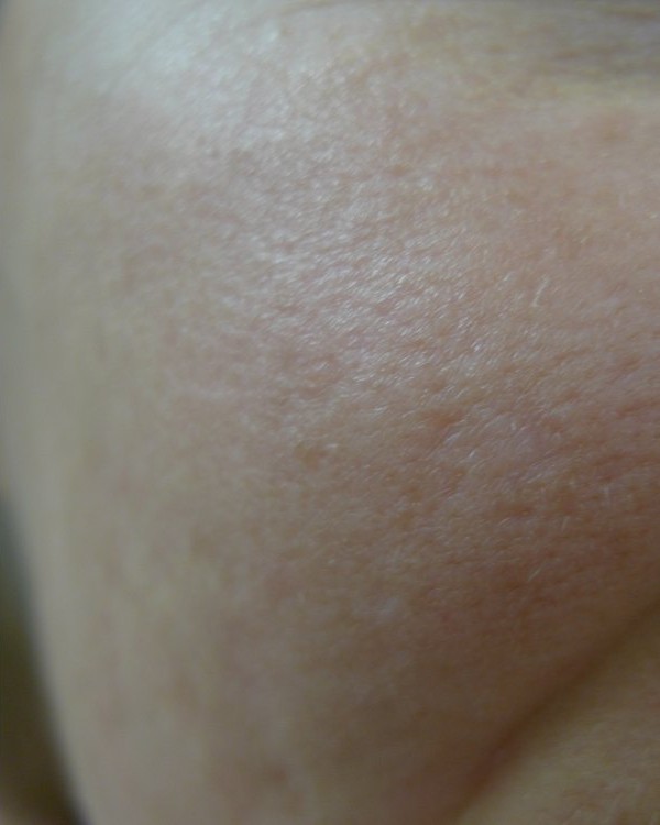 The same cheek after TCA treatment