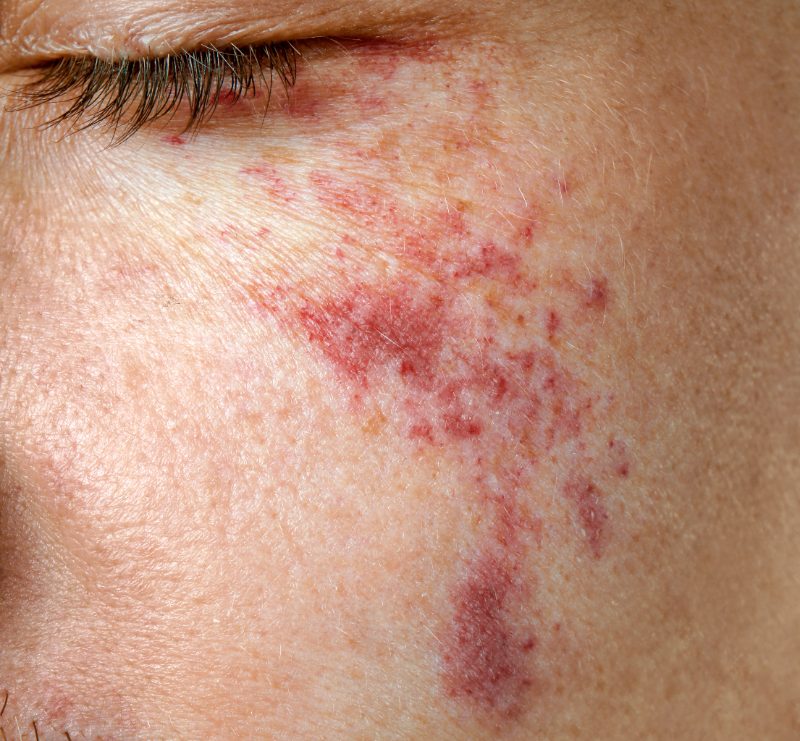 Birthmarks