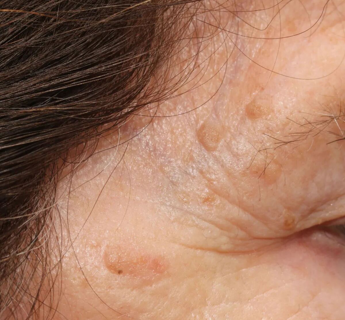Raised brown age warts at the temple