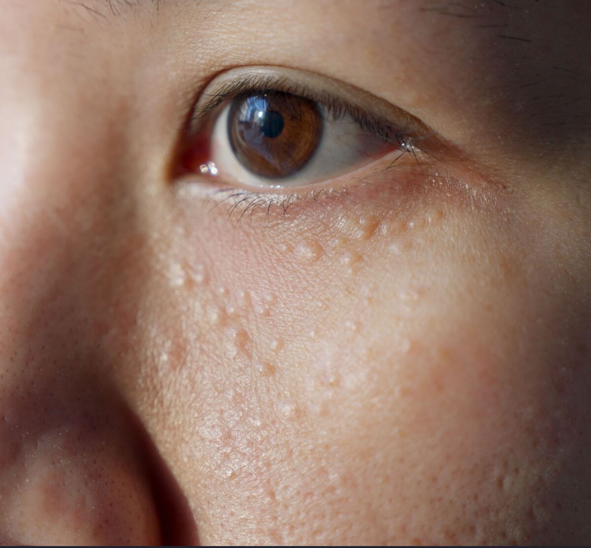 Small skin-coloured bumps under the eye