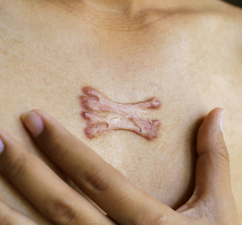 Raised & keloid scars