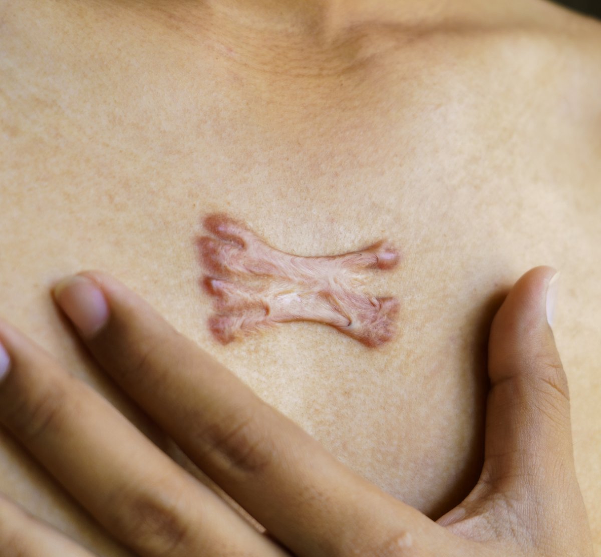 Keloid scar on the chest