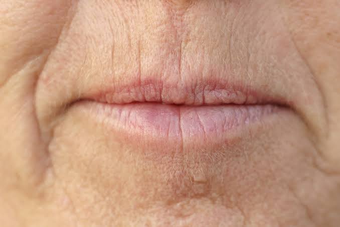 Vertical lines around the lips