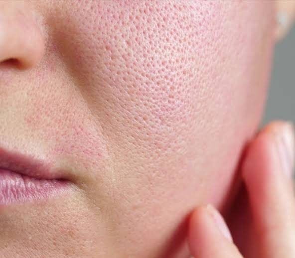 Enlarged pores across the cheek