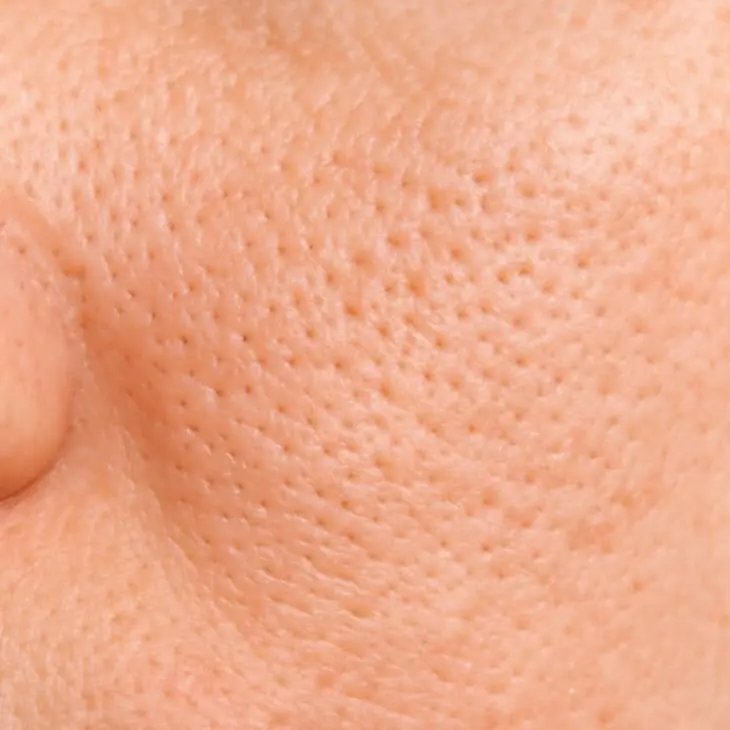 Enlarged pores across the cheek