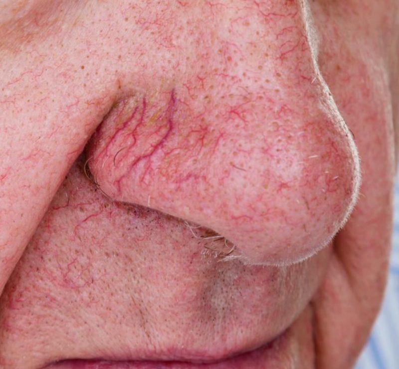 Thread veins & capillaries