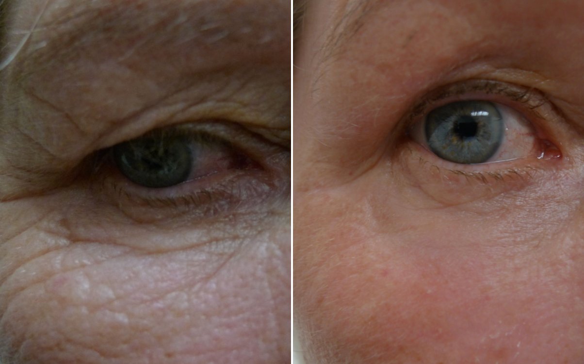 Lines and crepey skin around the eye before and after fully ablative erbium resurfacing