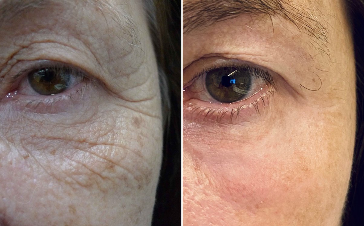Lines and crepey skin around the eye before and after fully ablative erbium resurfacing