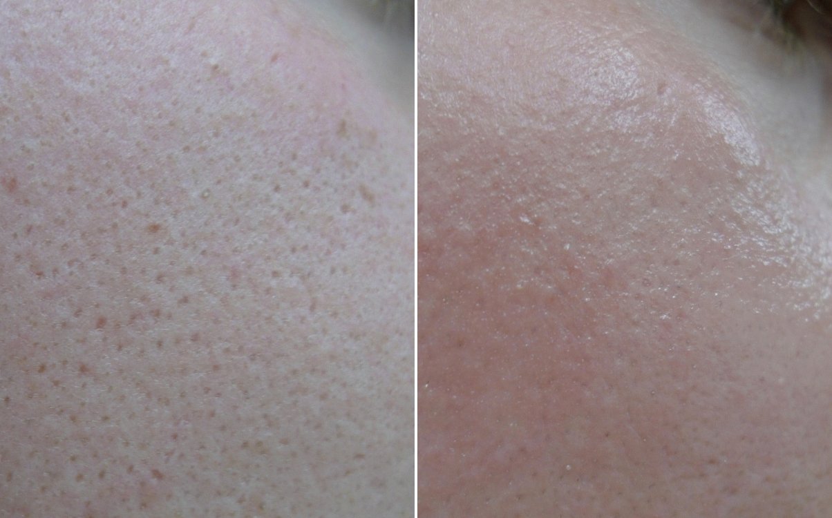 Age warts on the cheek before and after fully ablative erbium resurfacing