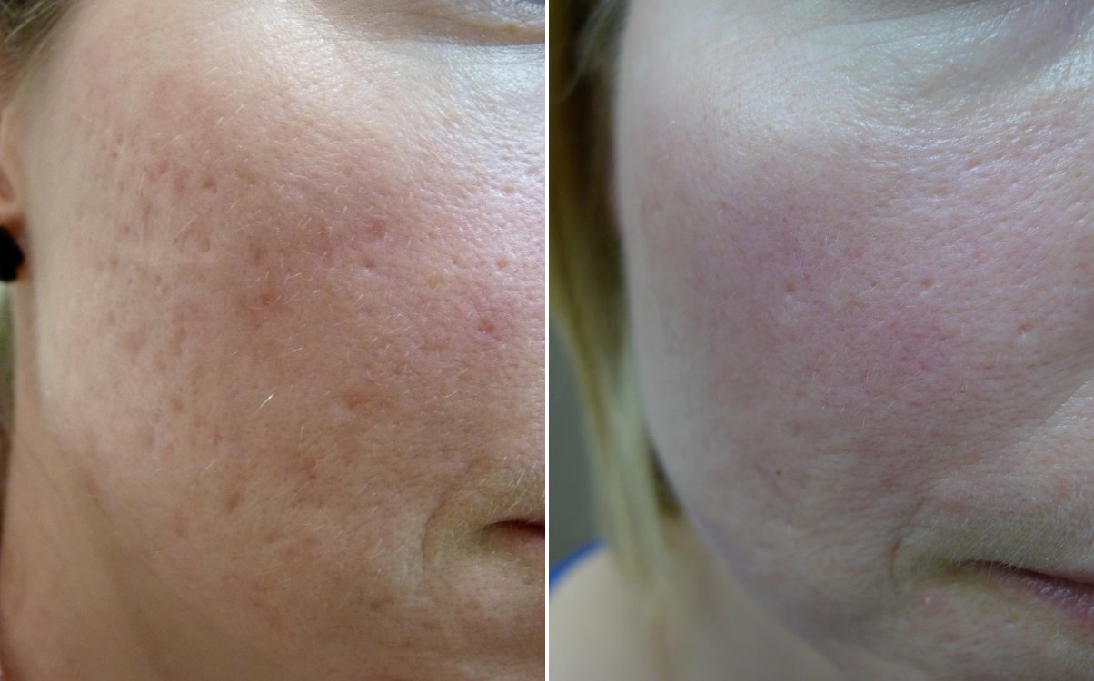 Acne scarring before and after fully ablative erbium resurfacing
