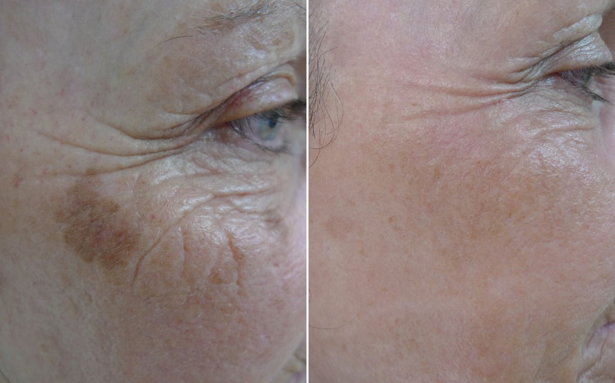Sun damage and pigment before and after fully ablative erbium resurfacing