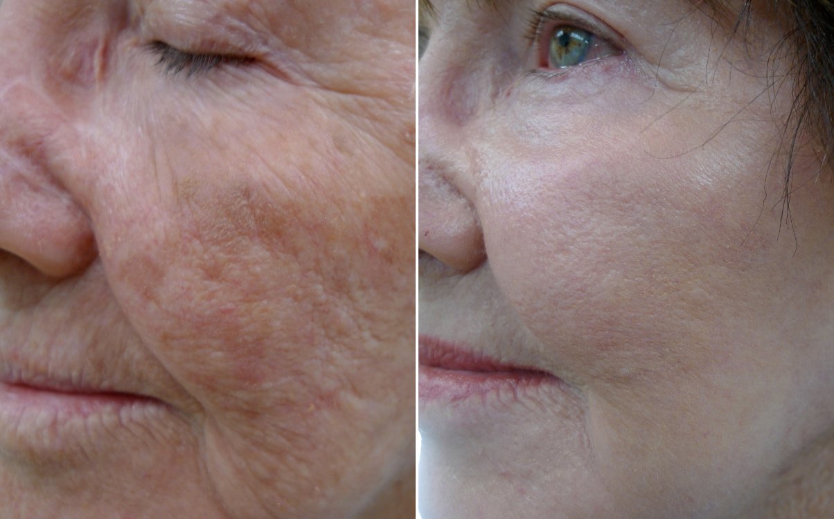 Wrinkles and texture of the face before and after fully ablative erbium resurfacing