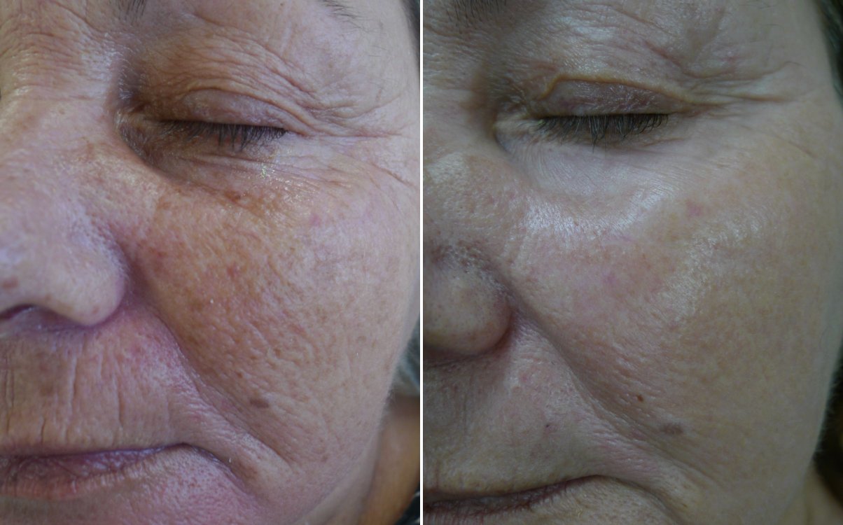 Wrinkles and texture of the face before and after fully ablative erbium resurfacing