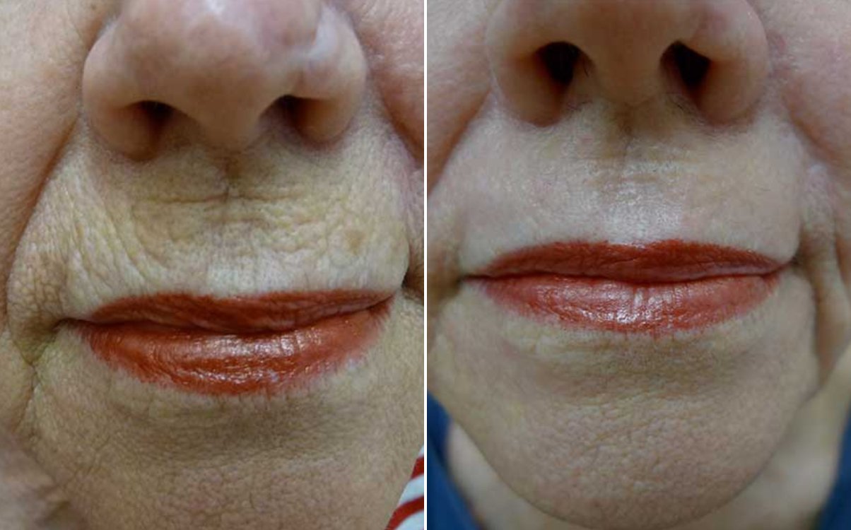 Lines around the lips before and after fully ablative erbium resurfacing