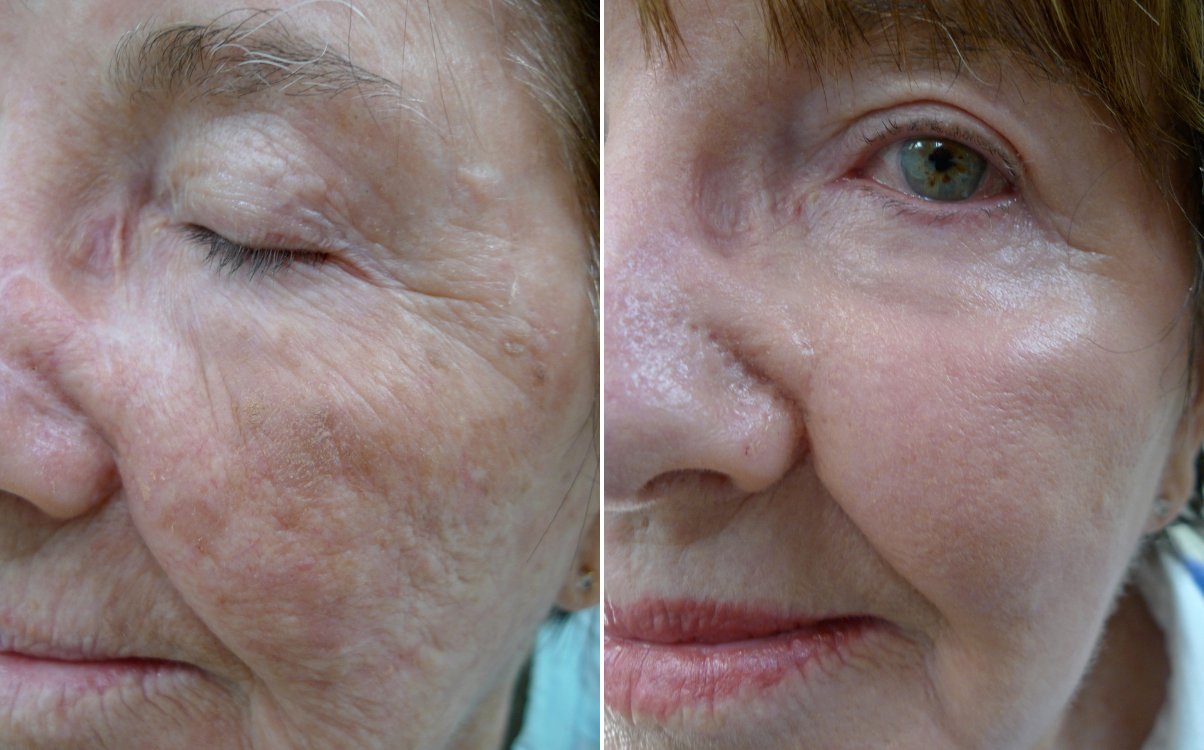 Wrinkles and texture of the face before and after fully ablative erbium resurfacing