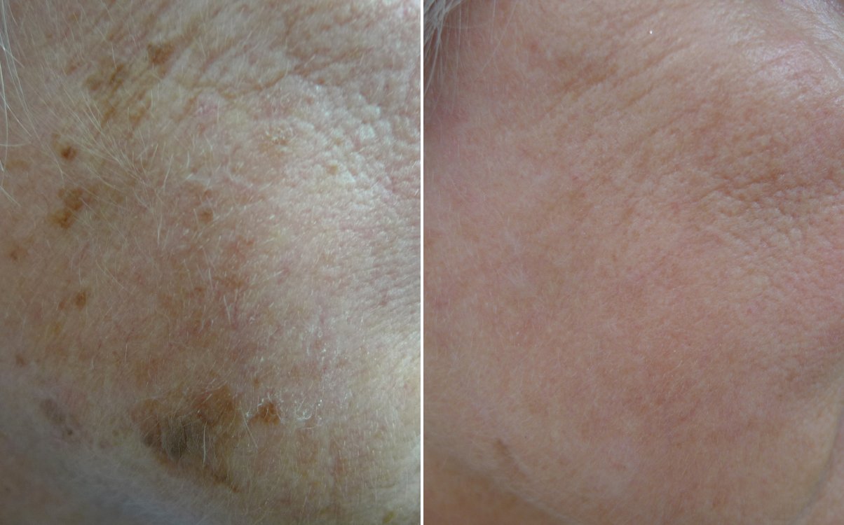 Sun damage and pigment before and after fully ablative erbium resurfacing
