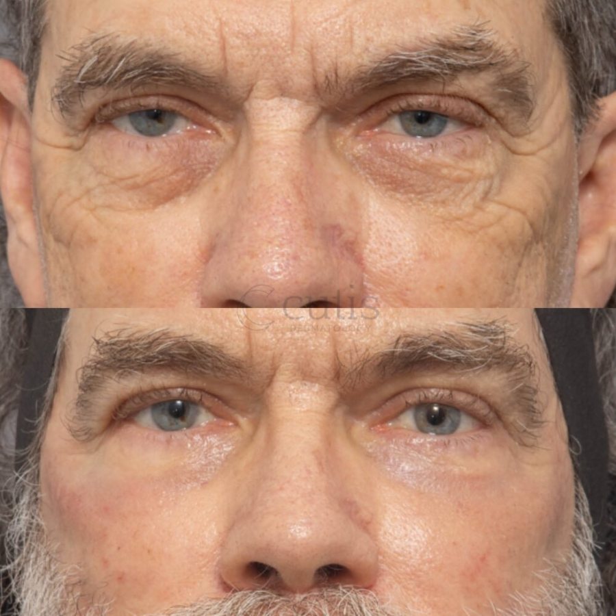 Lower eyelid and crow’s feet before and after fully ablative CO2 resurfacing