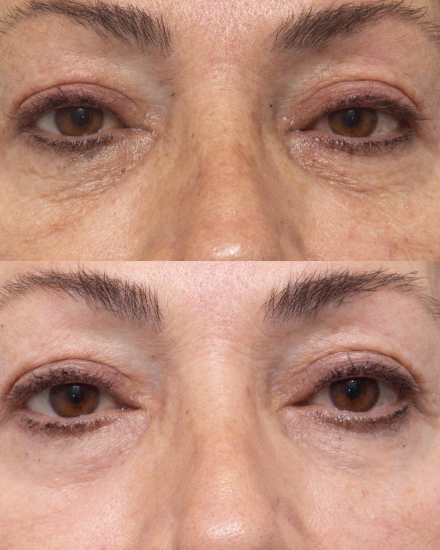 Crepey lower lid skin before and after fully ablative CO2 resurfacing