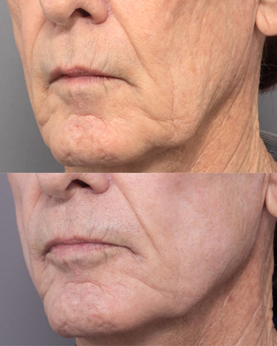 Perioral lines before and after fully ablative CO2 resurfacing, oblique view