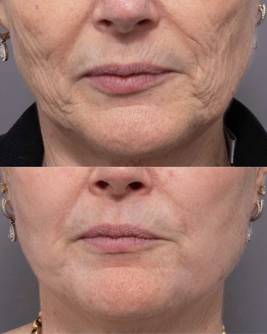 Lines around the lips before and after fully ablative CO2 resurfacing, front view