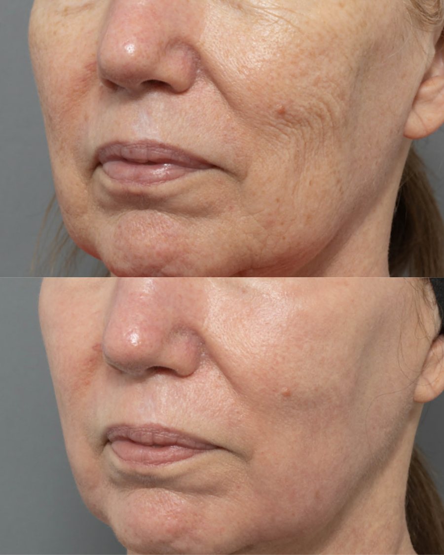Sun-damaged cheek skin before and after fully ablative CO2 resurfacing